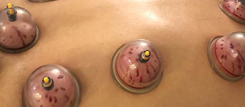 Hijama Hijama